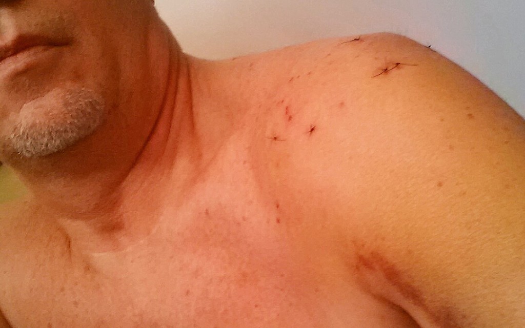 camera-related-injuries-macomber-productions